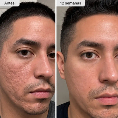 Stick Clínico Reparador de Cicatrices de Acné™