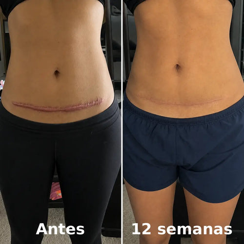 Stick Remodelador de Cicatrices Quirúrgicas™